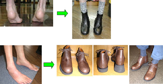 脚長差と保険適用の整形靴